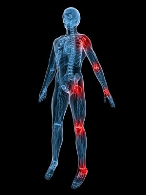 infectious -arthritis5 Вирусные артриты