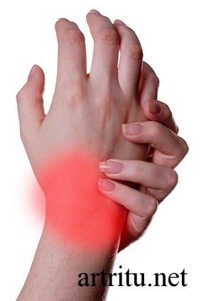 infectious -arthritis6 Лечение инфекционного артрита