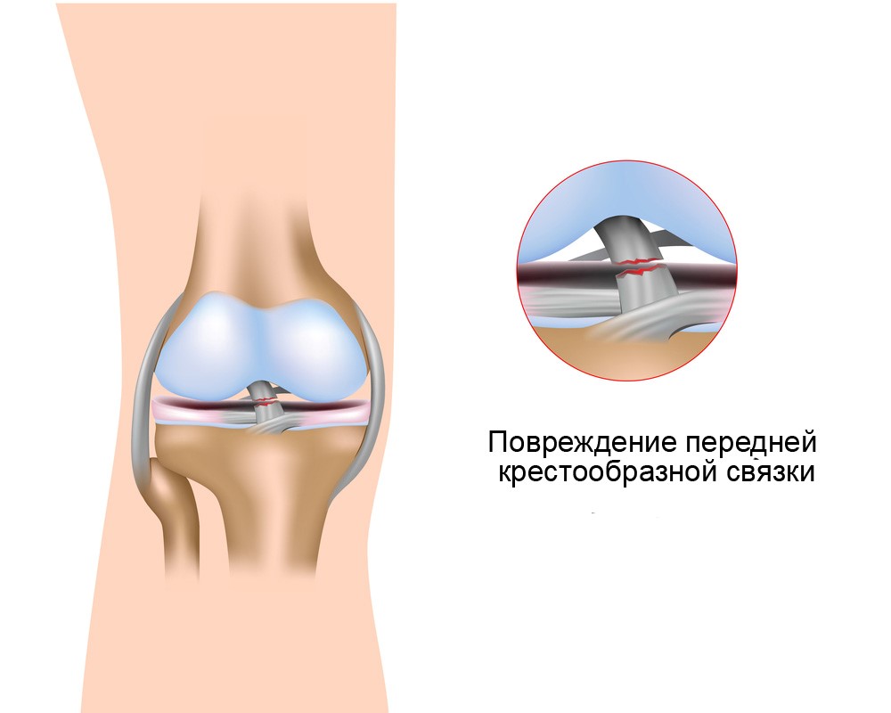 Повреждение передней крестообразной связки