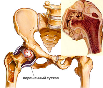 Коксит тазобедренного сустава