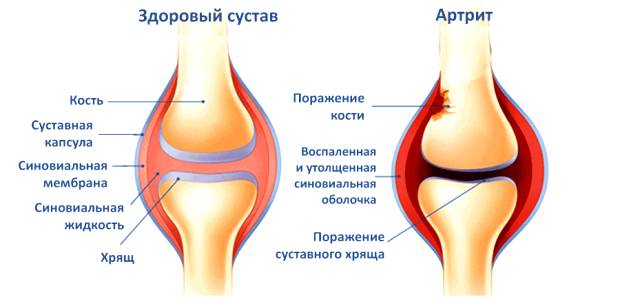 Признаки артрита