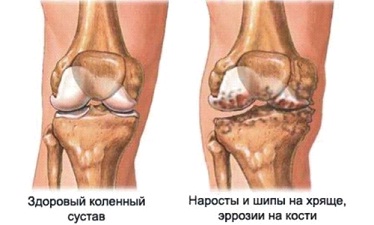 препарат «Пиаскледин» стимулирует анаболические процессы
