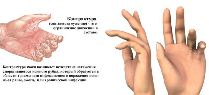 Контрактура сустава Контрактура