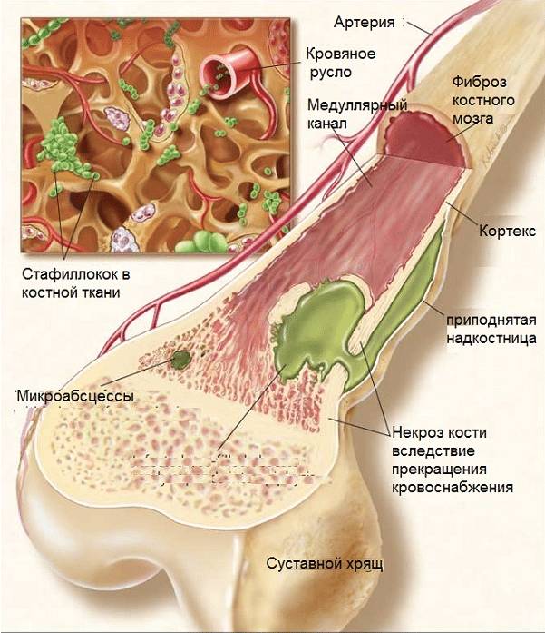 хронический остеомиелит