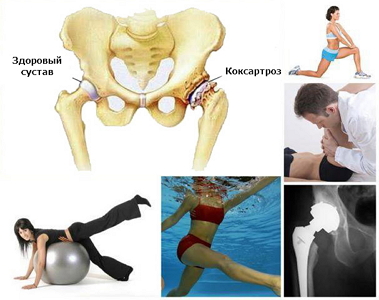 упражнения при коксартрозе