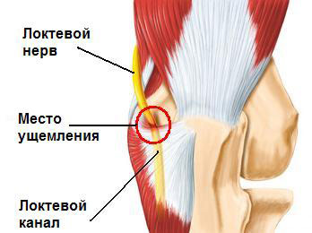 Признаки ущемления локтевого нерва