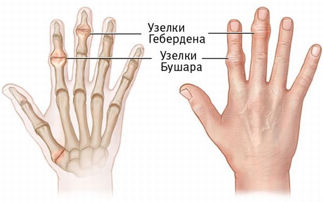 Симптомы ризартроза