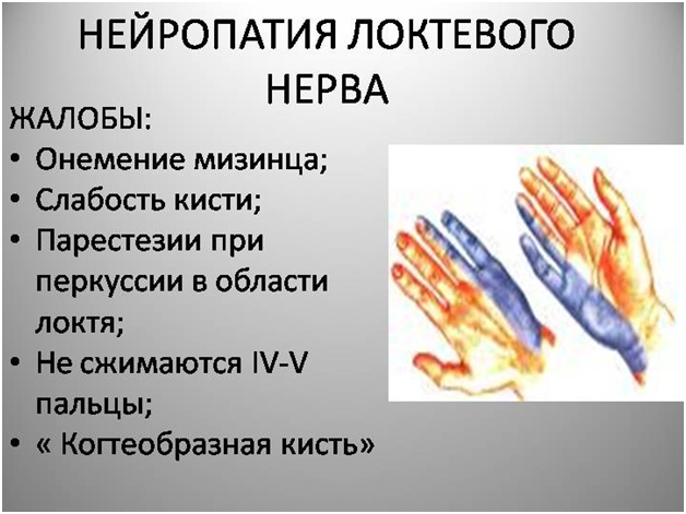 2. Нейропатия локтевого нерва