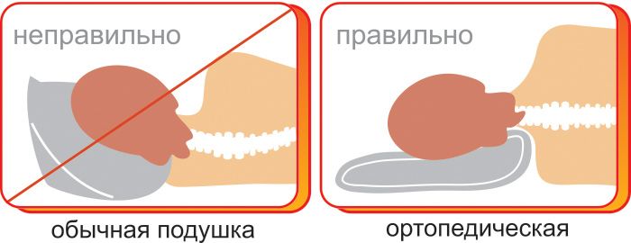 Ортопедическая подушка при шейном остеохондрозе