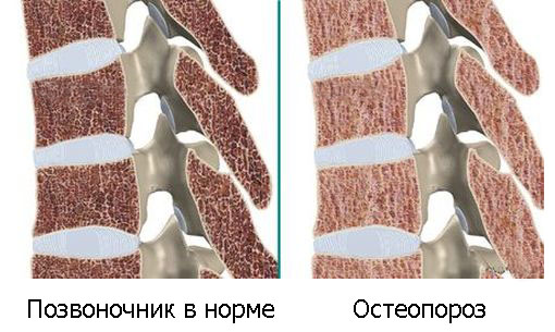 как проявляется остеопороз позвоночника