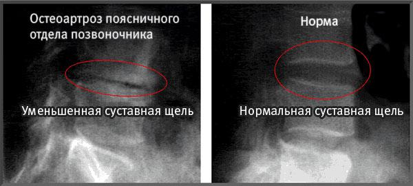 Остеоартроз поясничного отдела