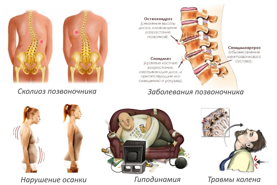 Остеохондроз