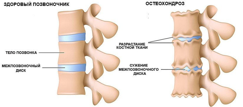 Почему возникает остеохондроз