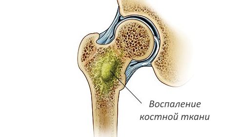 воспаление кости