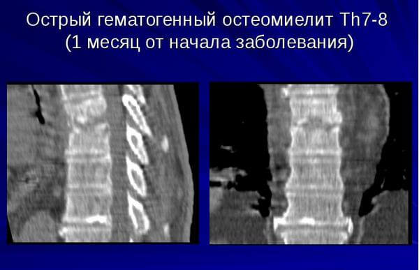 острый гематогенный остеомиелит