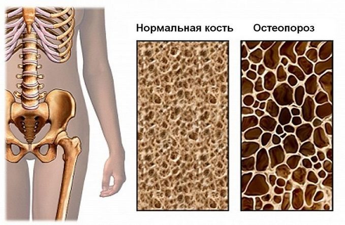 Остеопороз