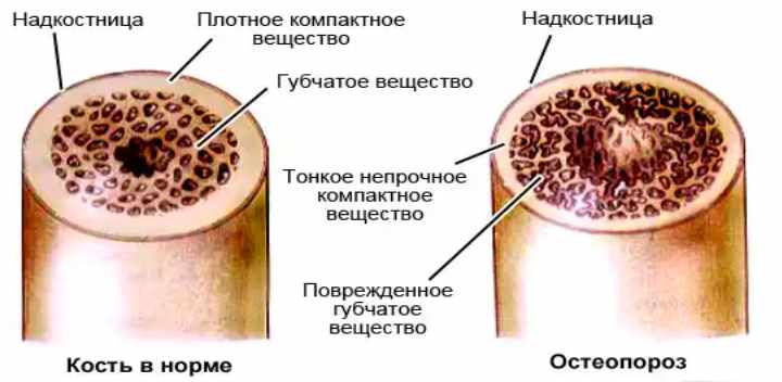 проявление остеопороза