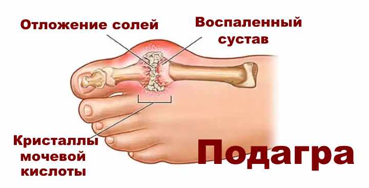 Отложение солей в суставах