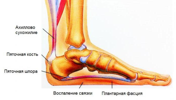 пяточная шпора