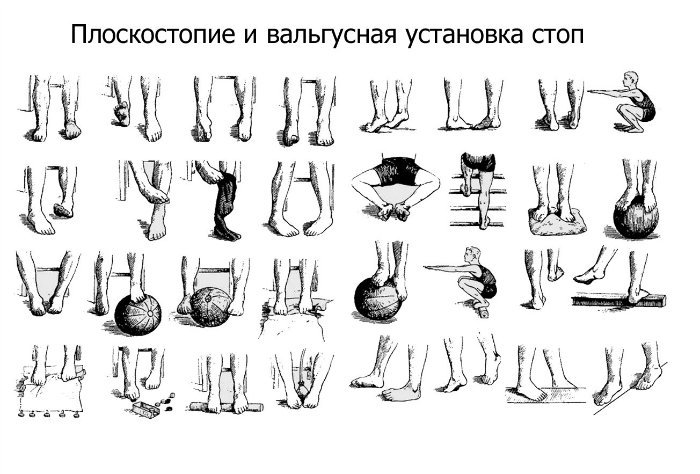 комплекс упражнений при плоскостопии