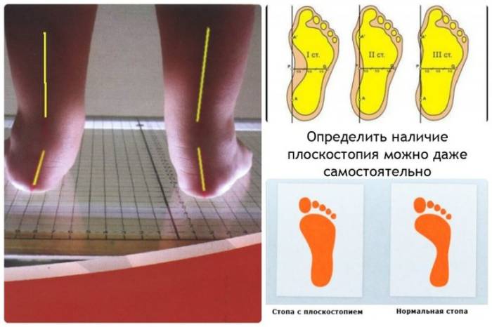 плоскостопие у детей