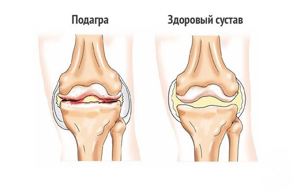 Больной и здоровый сустав