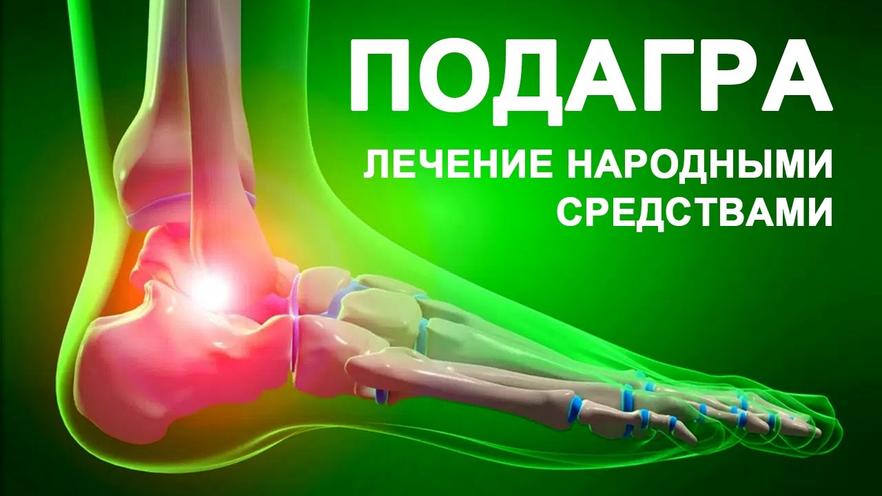 Лечение подагры народными средствами