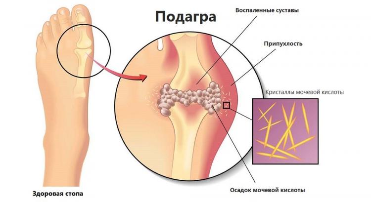 Подагра ноги