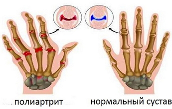 Народные средства при полиартрите: в каких случаях использовать, рецепты Полиартрит
