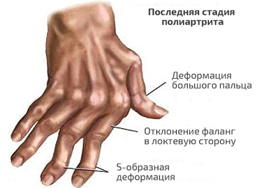 последняя стадия полиартрита