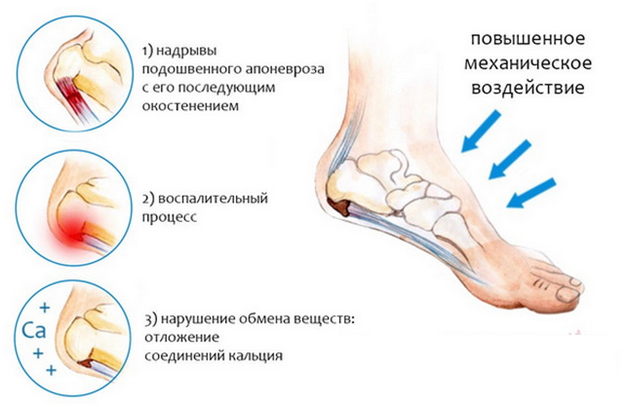 причины пяточной шпоры