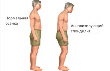 Анколизирующий спондилит