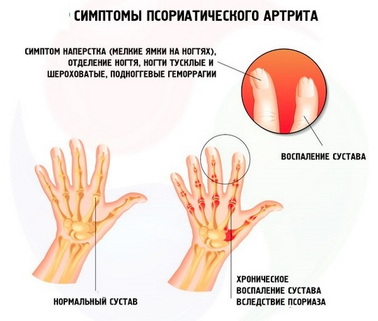 Прогноз псориатического артрита у детей