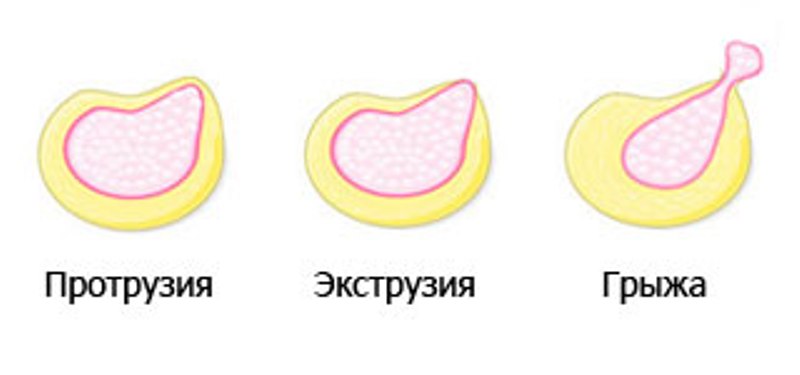Стадии заболевания