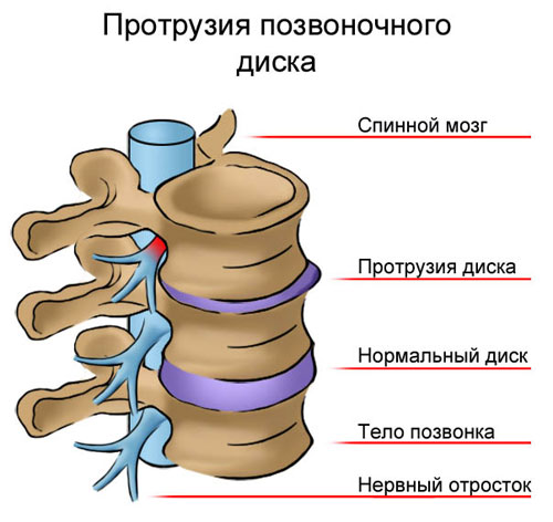 Протрузия шеи