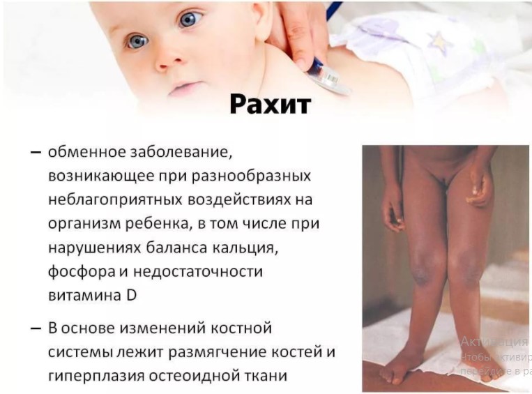 рахит у детей