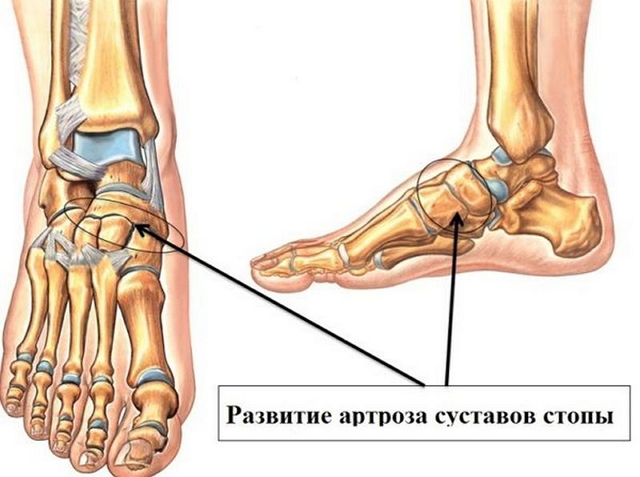 Развитие артроза стопы