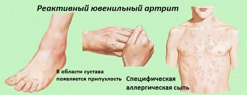 Реактивный ювенильный артрит