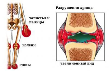 Ремиссия ювенильного ревматоидного артрита
