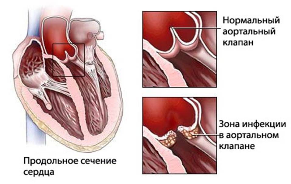 ревматизм сердца
