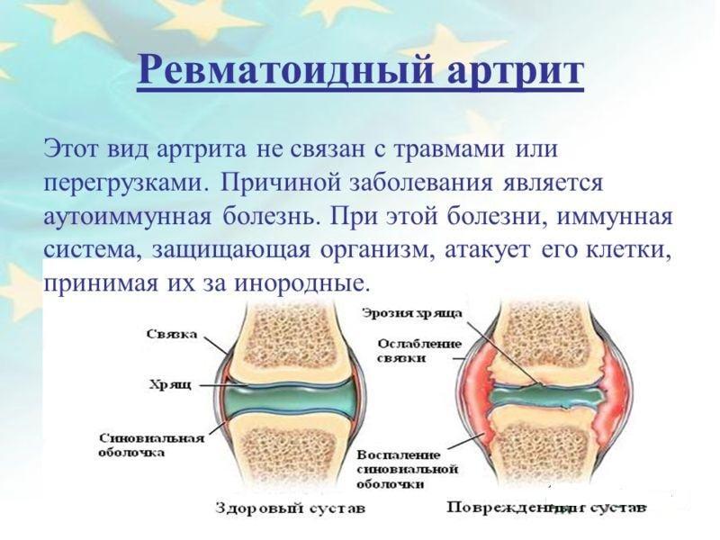 Ревматоидный артрит