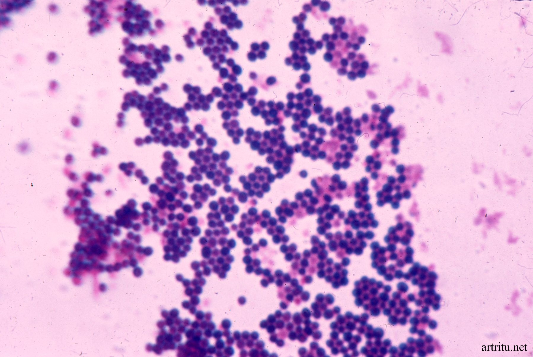 s.aureus Патогенез инфекционного артрита