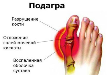 Симптомы подагры
