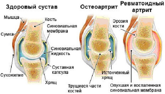 симптомы остеоартрита