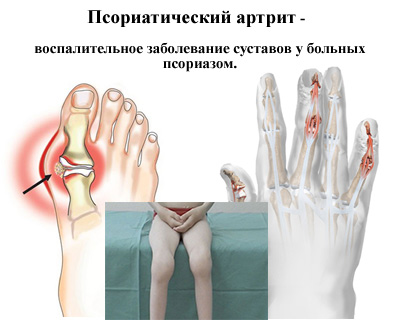 Симптомы псориатического артрита у детей