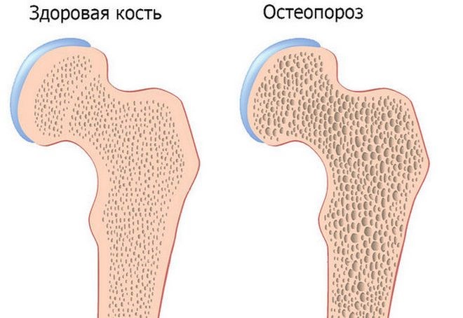 снижение плотности костей при остеопорозе
