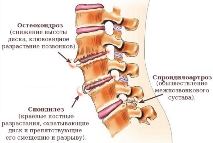 Спондилез и остеохондроз