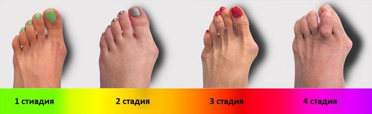 Стадии болезни