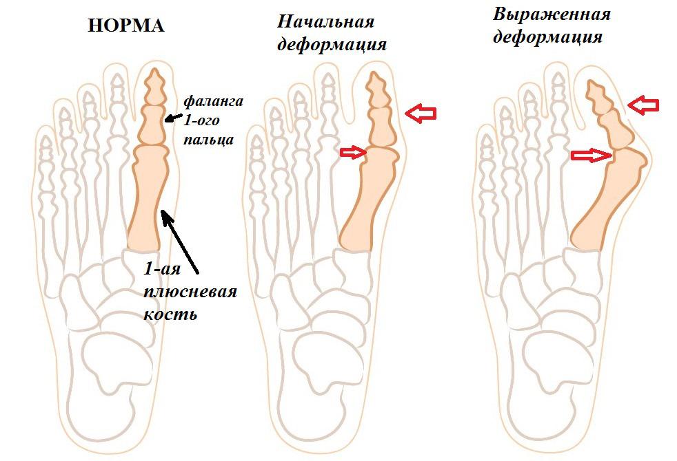 Стадии деформации