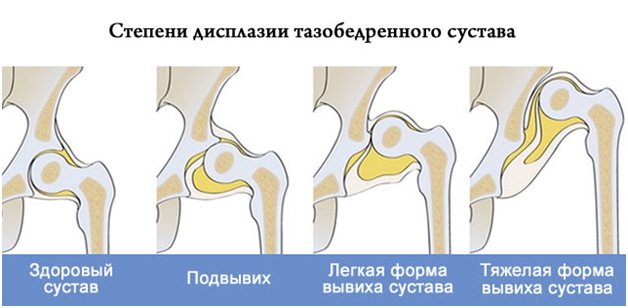Степени дисплазии